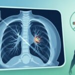 Dépistage Cancer du Poumon Généralisé d’Ici 2030