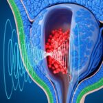 Cancer Prostate : Ultrasons Révolutionnent le Traitement